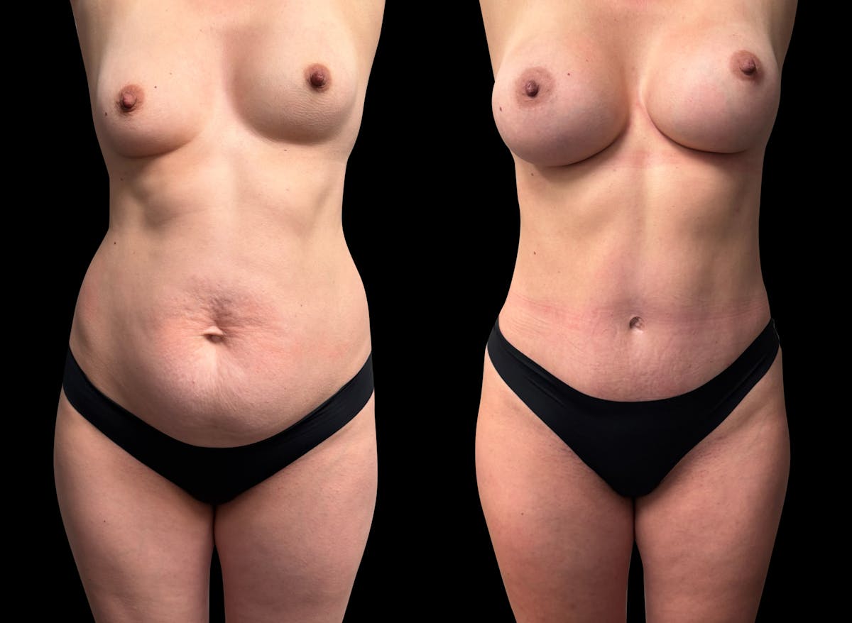 Tummy Tuck Before & After Gallery - Patient 423143 - Image 2
