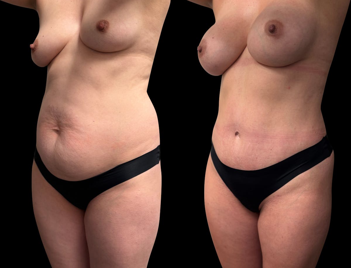 Tummy Tuck Before & After Gallery - Patient 423143 - Image 6