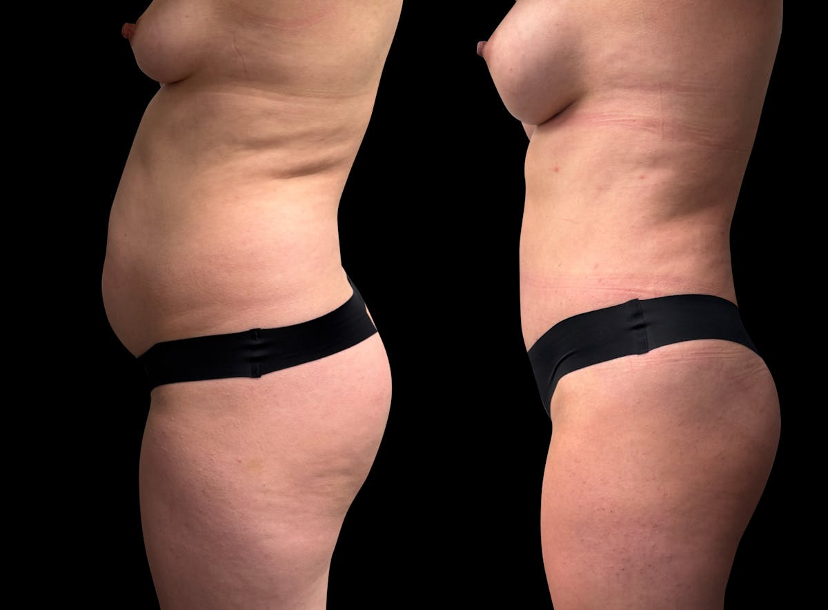 Tummy Tuck Before & After Gallery - Patient 423143 - Image 4