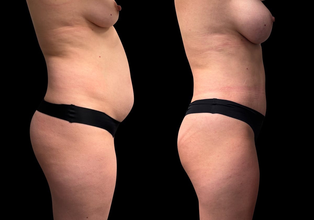 Tummy Tuck Before & After Gallery - Patient 423143 - Image 7