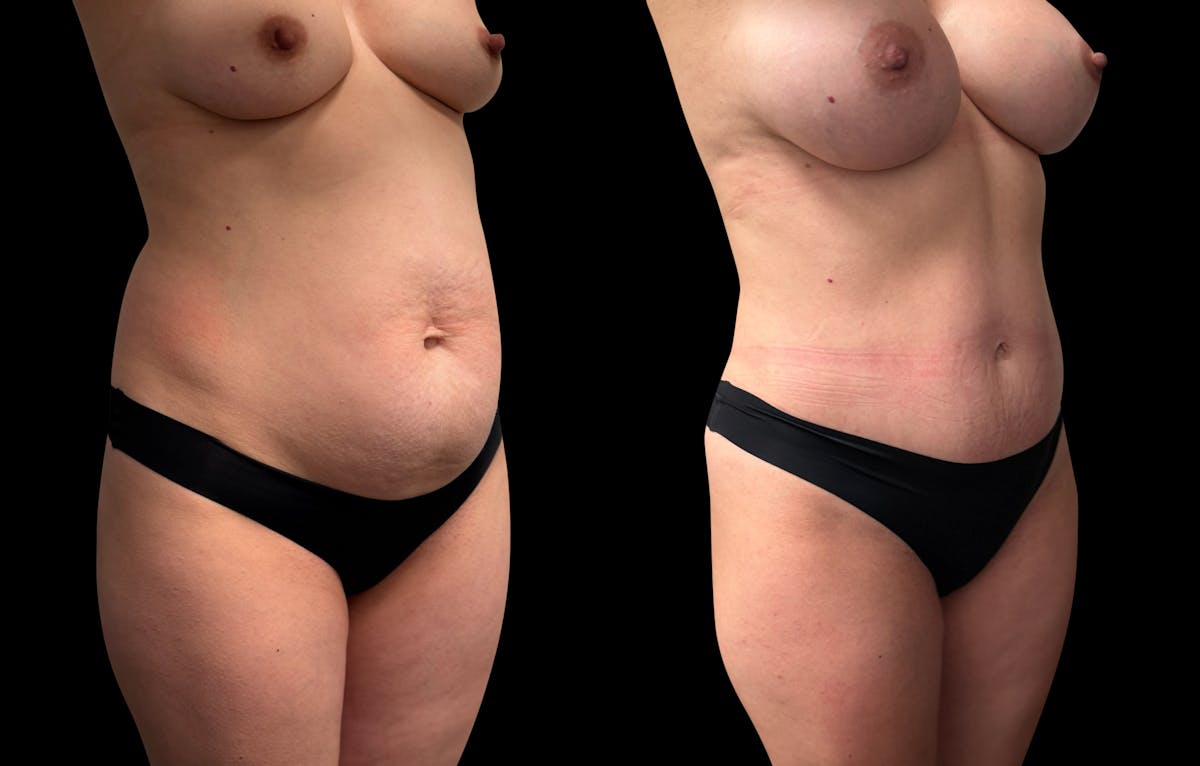 Tummy Tuck Before & After Gallery - Patient 423143 - Image 8