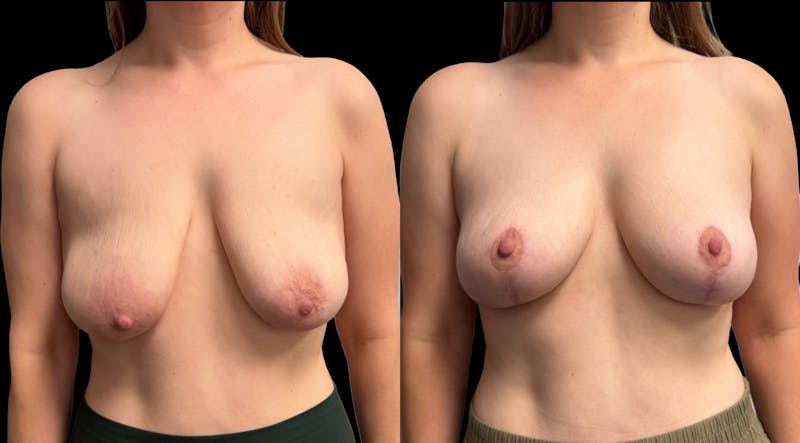 Breast Lift Before & After Gallery - Patient 136824 - Image 1