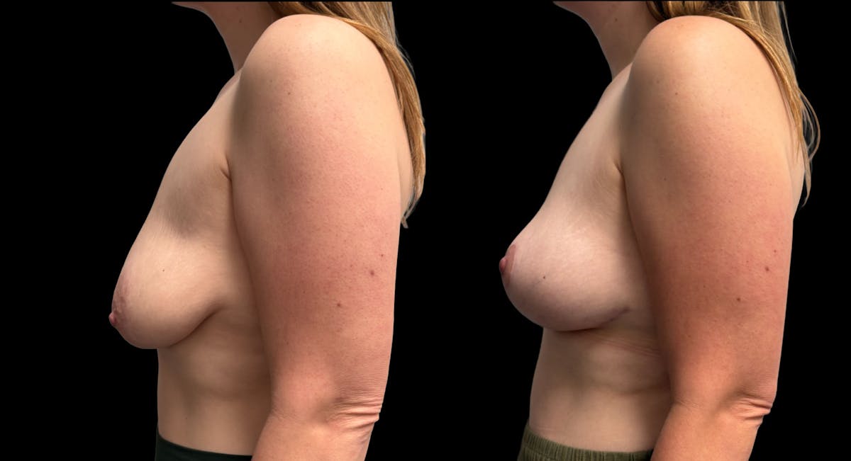 Breast Lift Before & After Gallery - Patient 136824 - Image 4