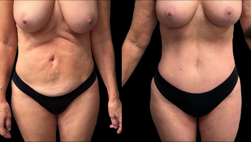 Tummy Tuck Before & After Gallery - Patient 427877 - Image 1
