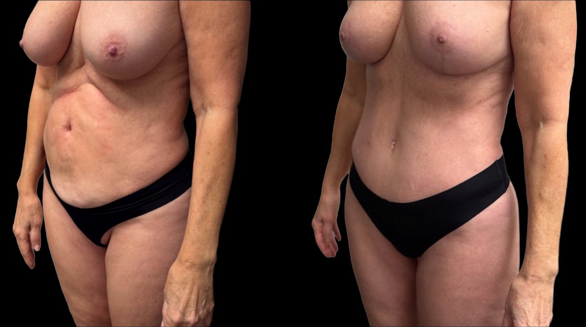 Tummy Tuck Before & After Gallery - Patient 427877 - Image 2