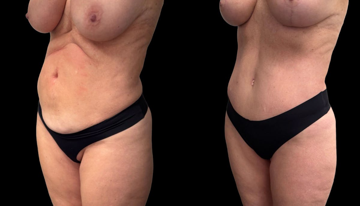 Tummy Tuck Before & After Gallery - Patient 427877 - Image 3