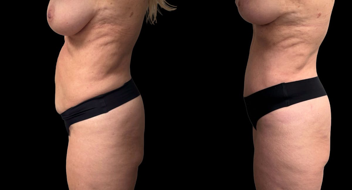 Tummy Tuck Before & After Gallery - Patient 427877 - Image 4