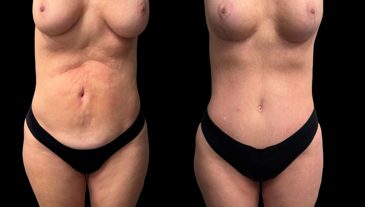 Tummy Tuck Before & After Gallery - Patient 427877 - Image 5