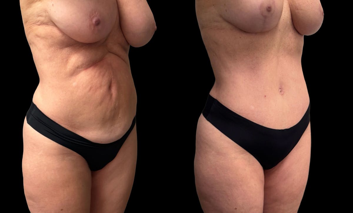 Tummy Tuck Before & After Gallery - Patient 427877 - Image 6