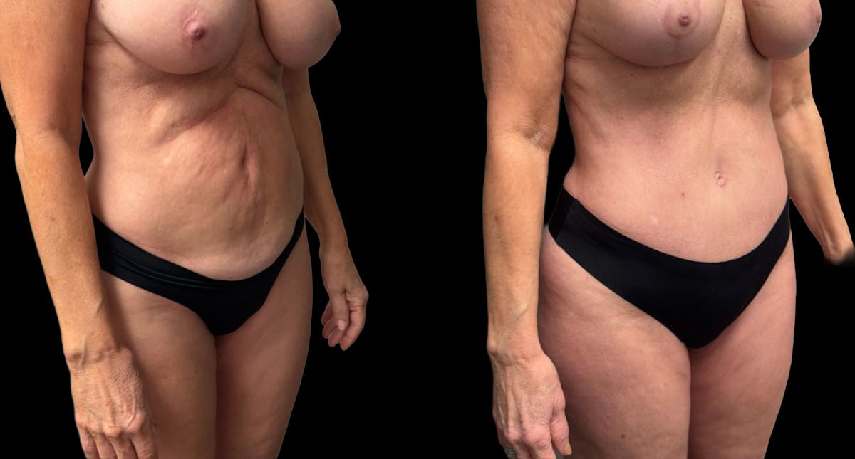Tummy Tuck Before & After Gallery - Patient 427877 - Image 7