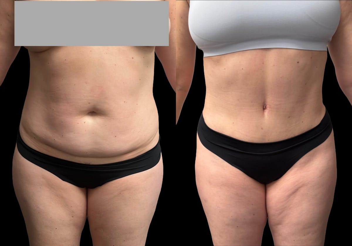 Tummy Tuck Before & After Gallery - Patient 158400 - Image 1