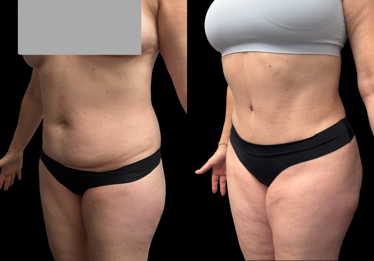 Tummy Tuck Before & After Gallery - Patient 158400 - Image 2
