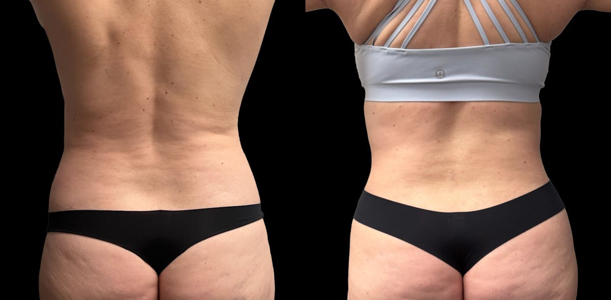 Tummy Tuck Before & After Gallery - Patient 158400 - Image 4