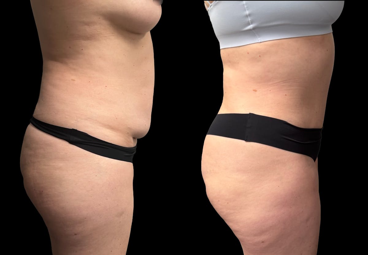 Tummy Tuck Before & After Gallery - Patient 158400 - Image 5