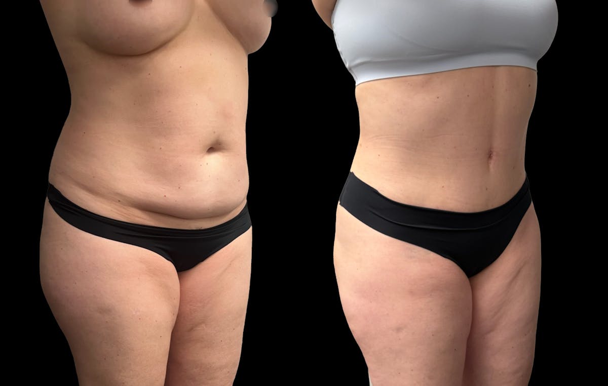Tummy Tuck Before & After Gallery - Patient 158400 - Image 6
