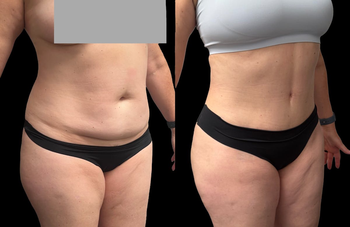Tummy Tuck Before & After Gallery - Patient 158400 - Image 7
