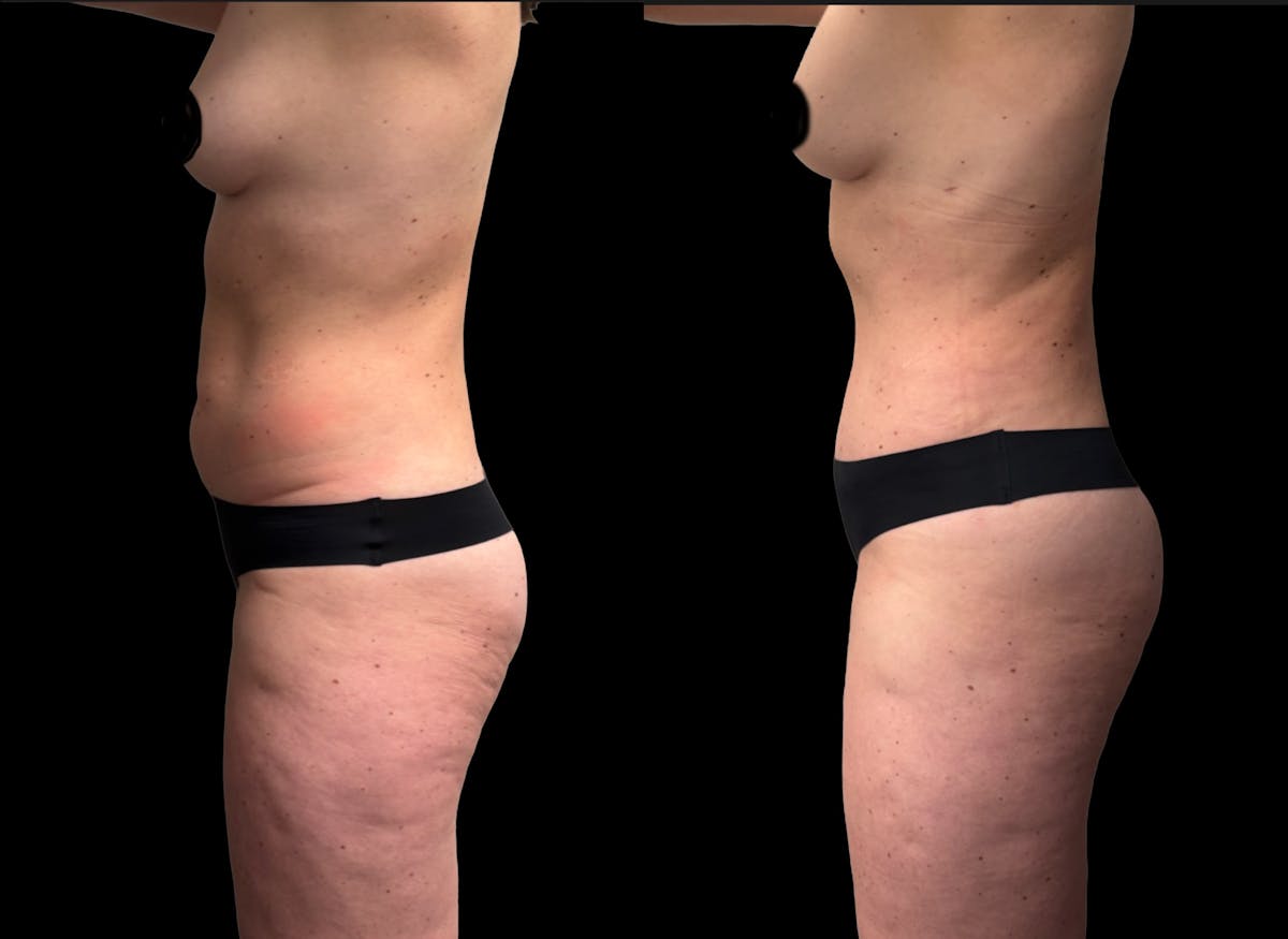 Tummy Tuck Before & After Gallery - Patient 186442 - Image 5