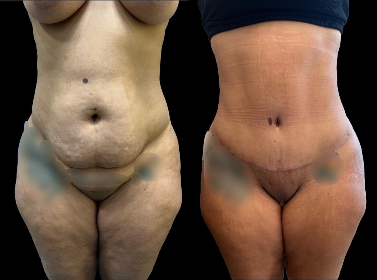 Tummy Tuck Before & After Gallery - Patient 287385 - Image 1