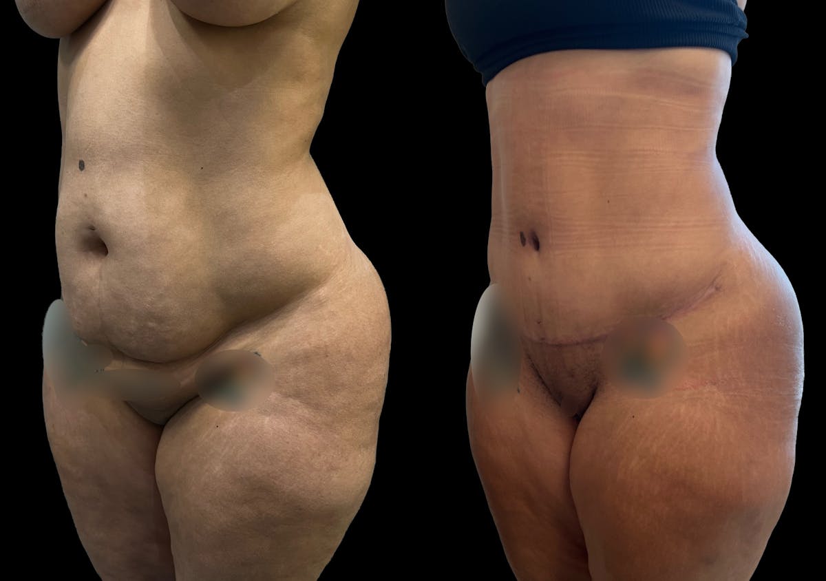 Tummy Tuck Before & After Gallery - Patient 287385 - Image 2
