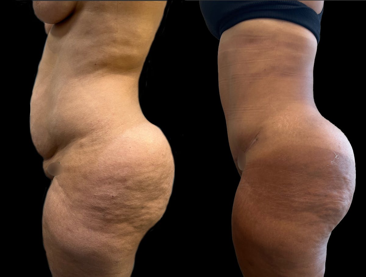 Tummy Tuck Before & After Gallery - Patient 287385 - Image 3