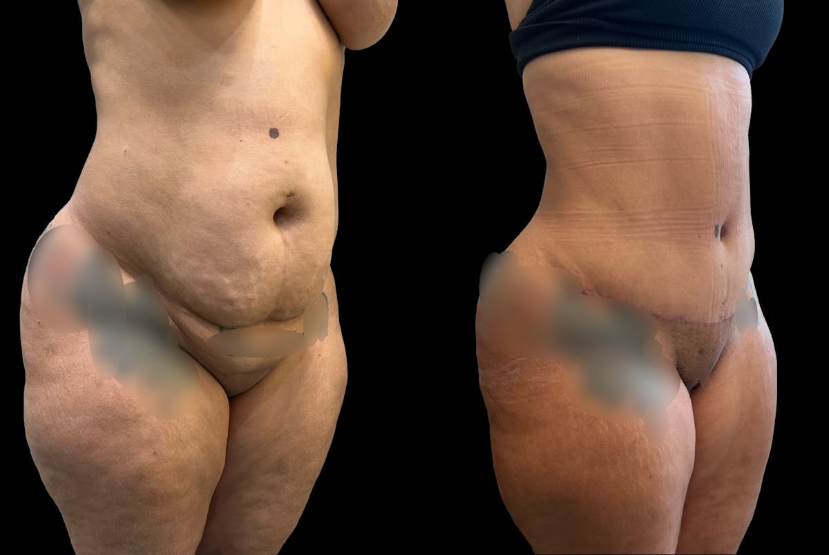 Tummy Tuck Before & After Gallery - Patient 287385 - Image 4