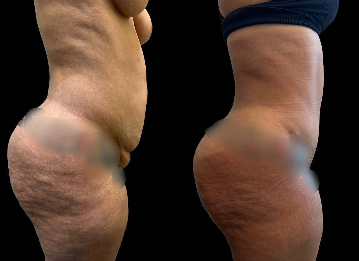 Tummy Tuck Before & After Gallery - Patient 287385 - Image 5