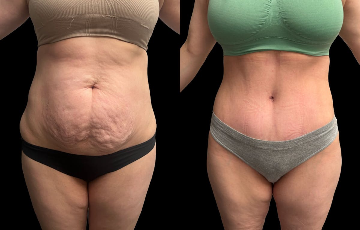 Tummy Tuck Before & After Gallery - Patient 187768 - Image 1