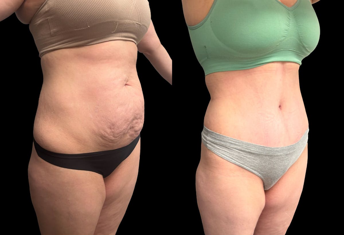 Tummy Tuck Before & After Gallery - Patient 187768 - Image 4