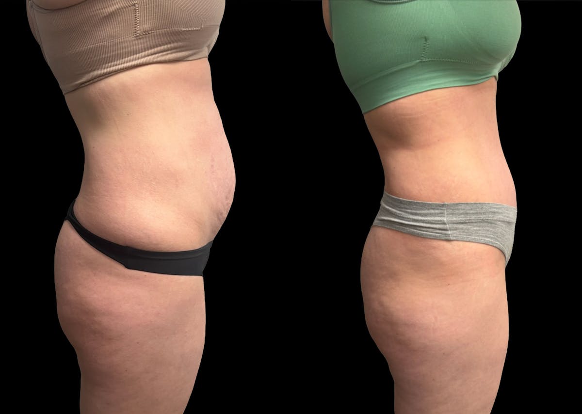 Tummy Tuck Before & After Gallery - Patient 187768 - Image 5