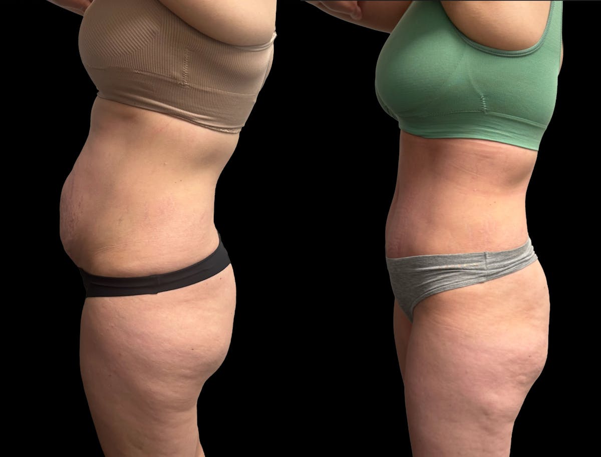 Tummy Tuck Before & After Gallery - Patient 187768 - Image 3
