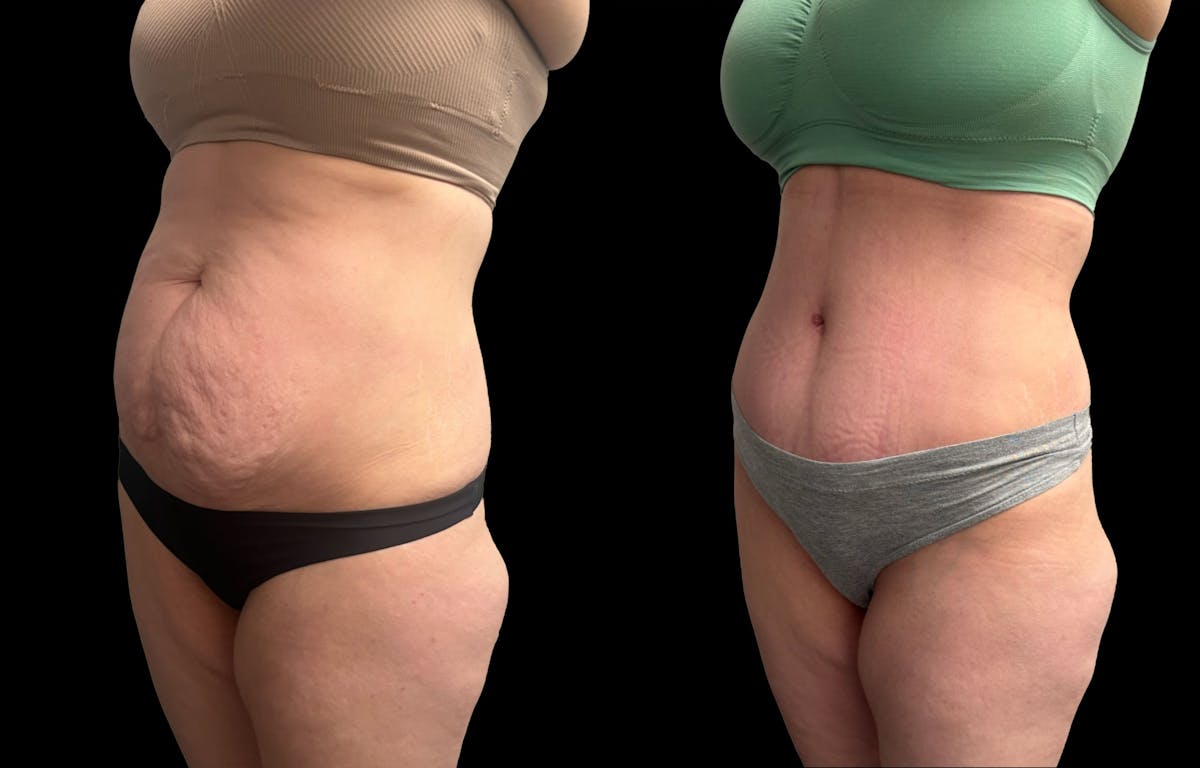 Tummy Tuck Before & After Gallery - Patient 187768 - Image 2