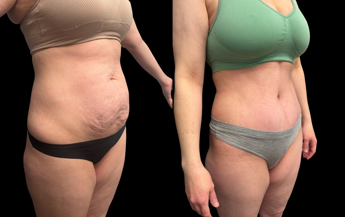 Tummy Tuck Before & After Gallery - Patient 187768 - Image 6