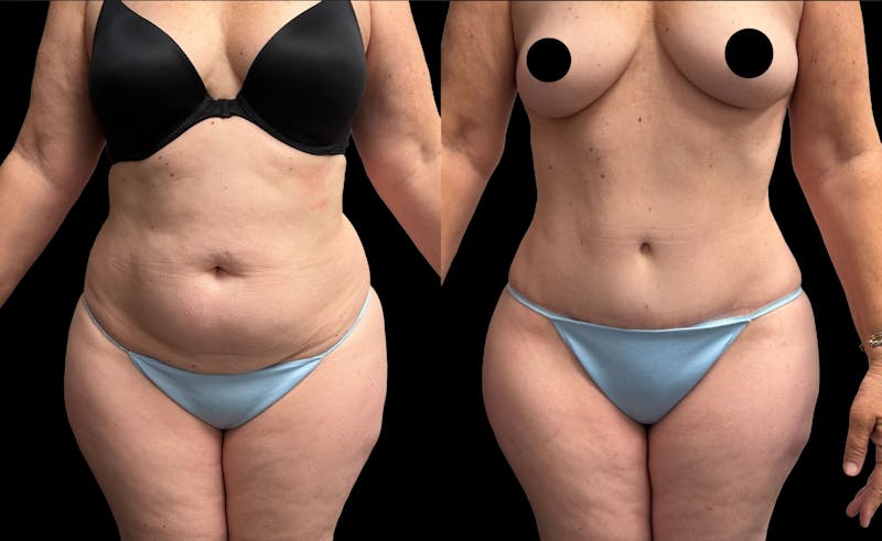 Tummy Tuck Before & After Gallery - Patient 455763 - Image 1