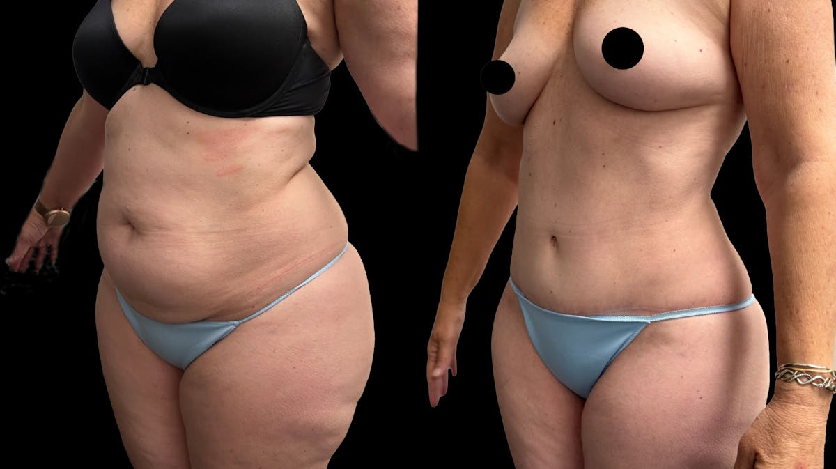 Tummy Tuck Before & After Gallery - Patient 455763 - Image 2