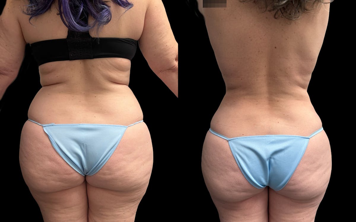 Tummy Tuck Before & After Gallery - Patient 455763 - Image 3