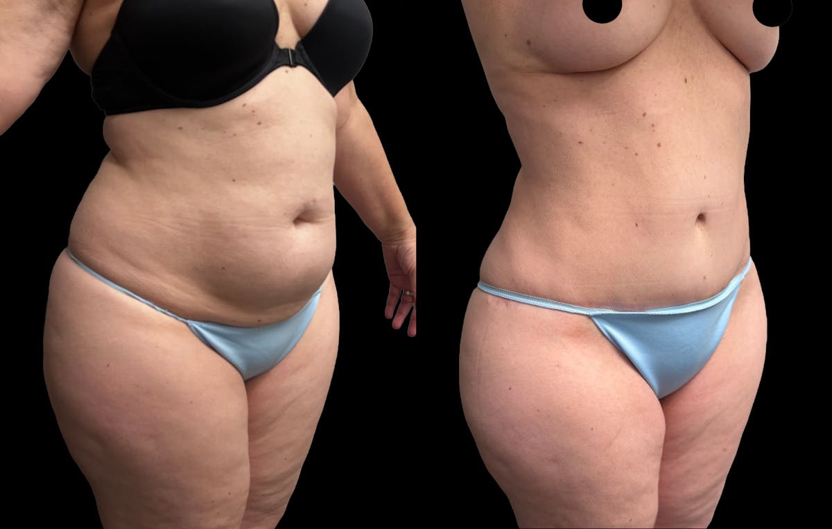 Tummy Tuck Before & After Gallery - Patient 455763 - Image 4