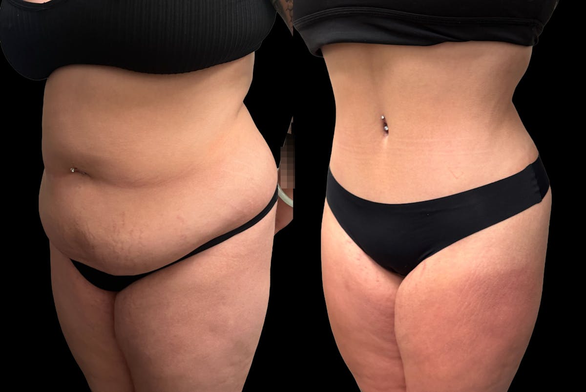 Tummy Tuck Before & After Gallery - Patient 489516 - Image 2