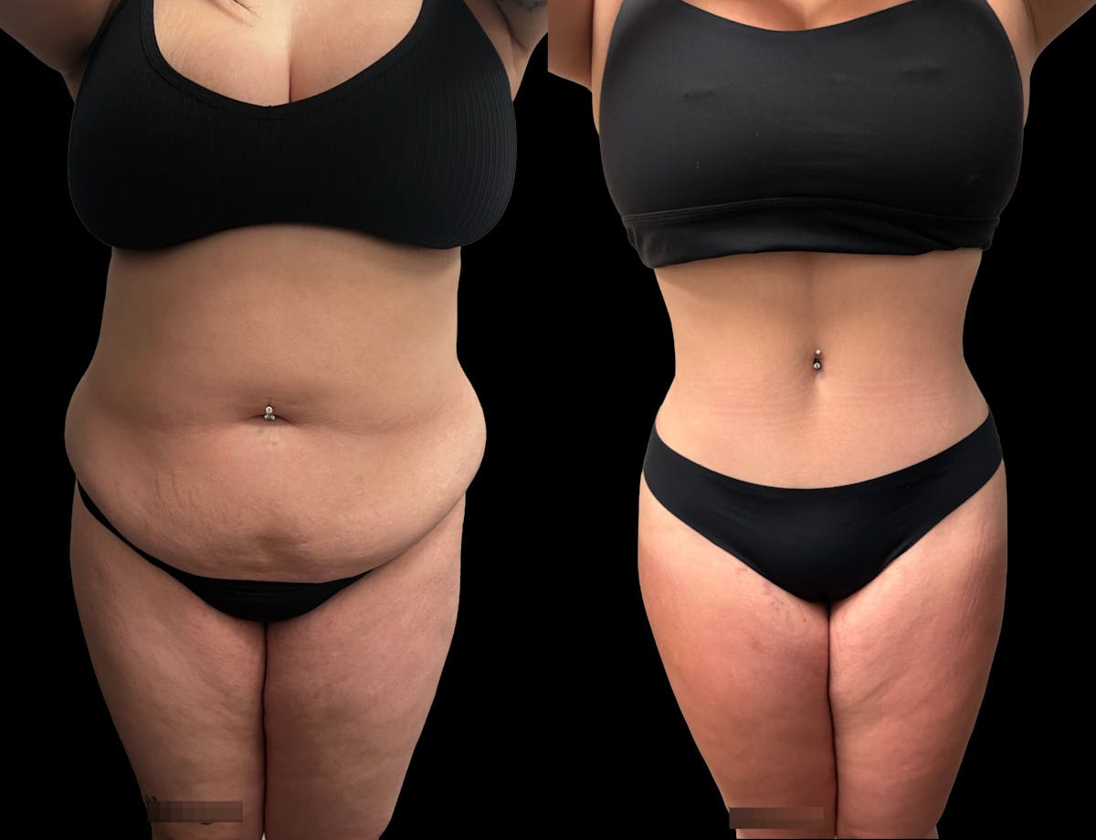 Tummy Tuck Before & After Gallery - Patient 489516 - Image 1