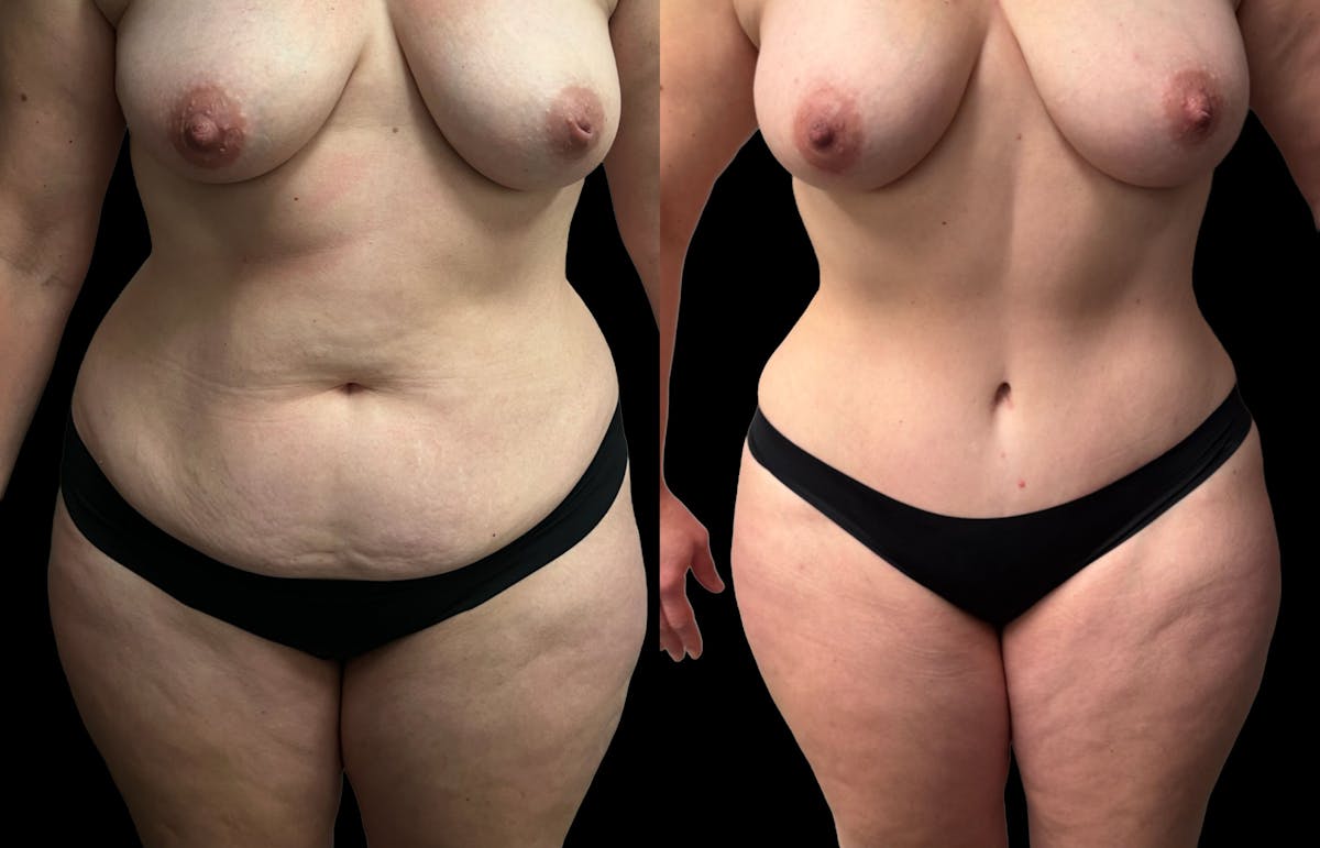 Tummy Tuck Before & After Gallery - Patient 269437 - Image 1