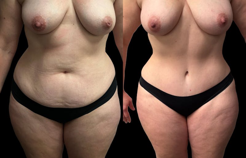Tummy Tuck Before & After Gallery - Patient 269437 - Image 1
