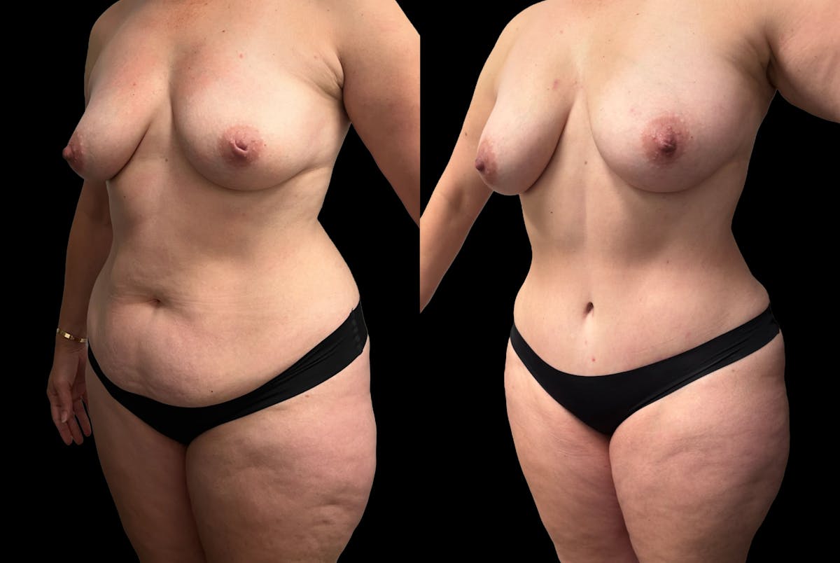 Tummy Tuck Before & After Gallery - Patient 269437 - Image 2
