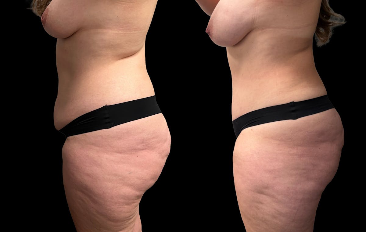 Tummy Tuck Before & After Gallery - Patient 269437 - Image 3