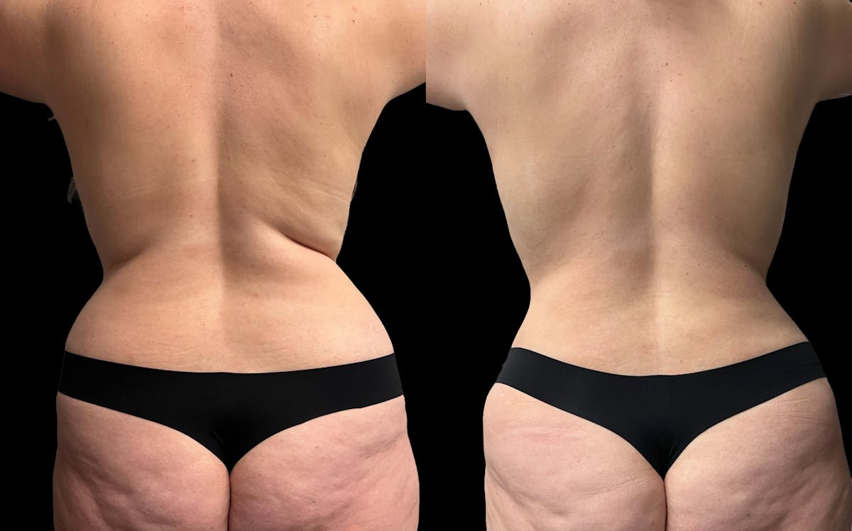 Tummy Tuck Before & After Gallery - Patient 269437 - Image 4