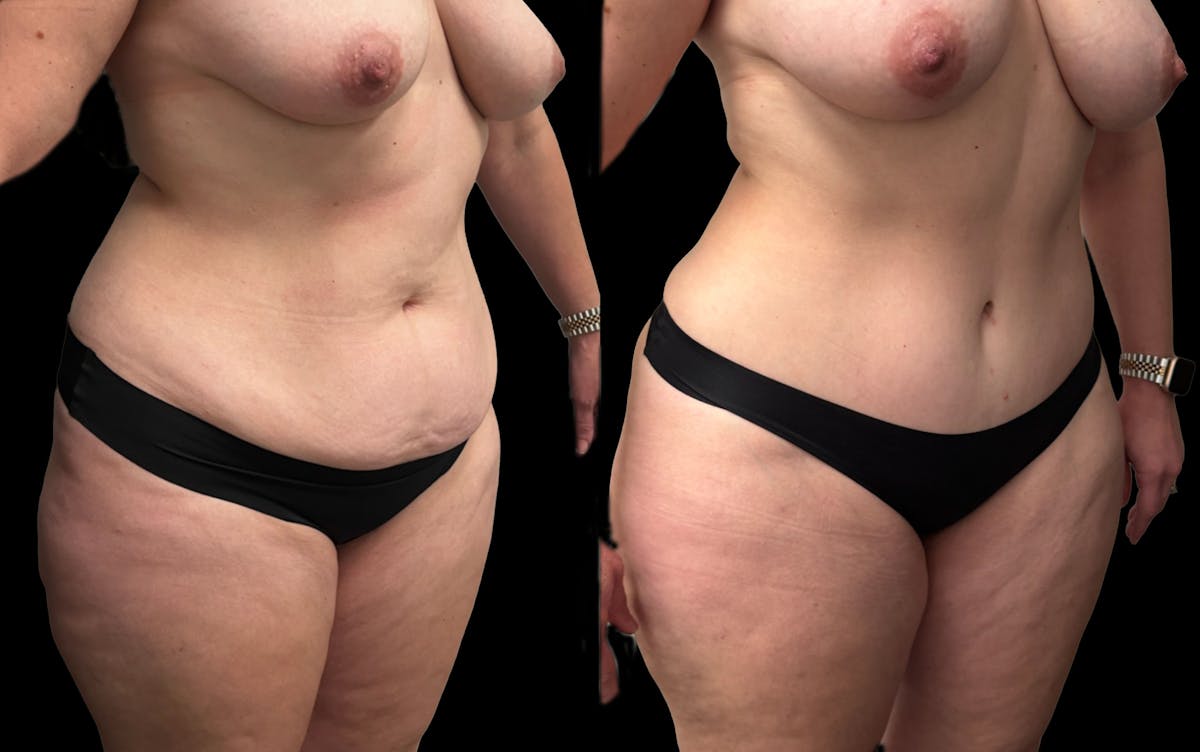Tummy Tuck Before & After Gallery - Patient 269437 - Image 5