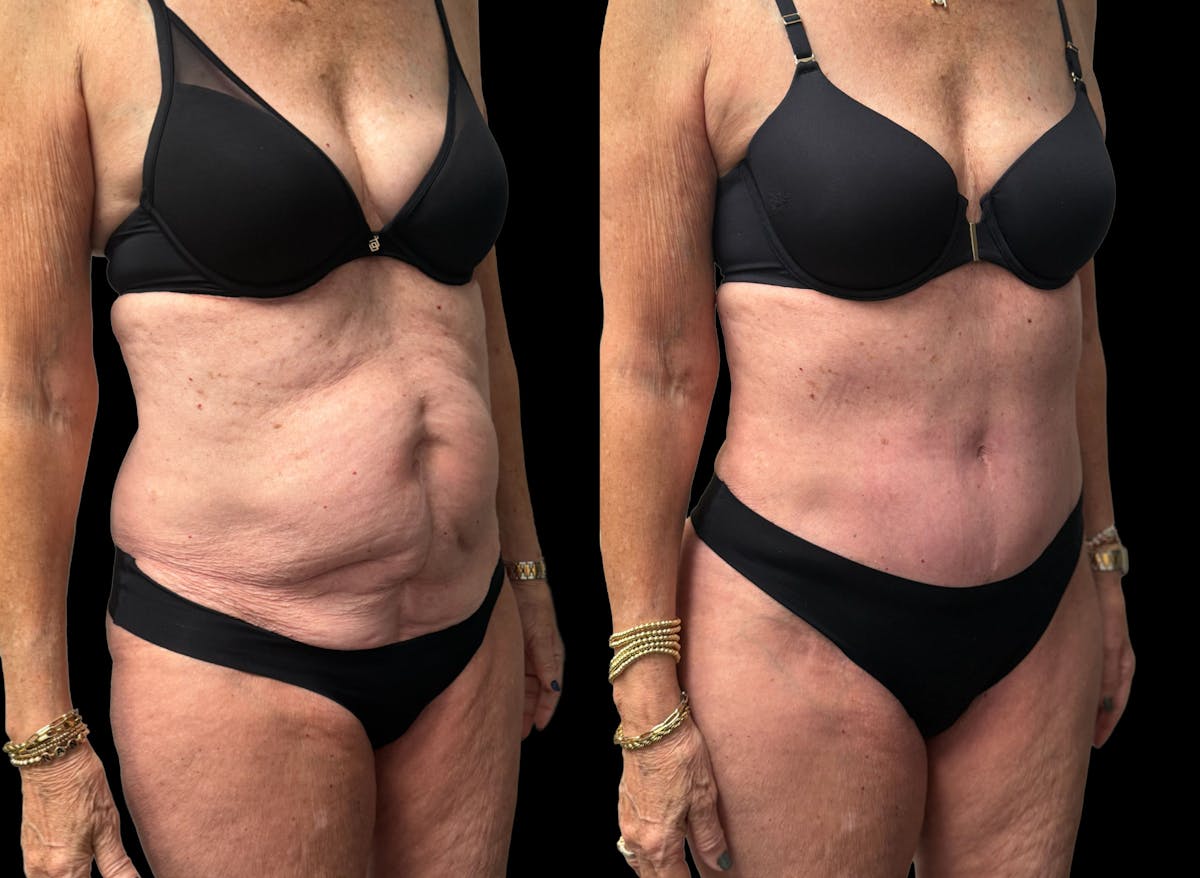 Tummy Tuck Before & After Gallery - Patient 197665 - Image 6