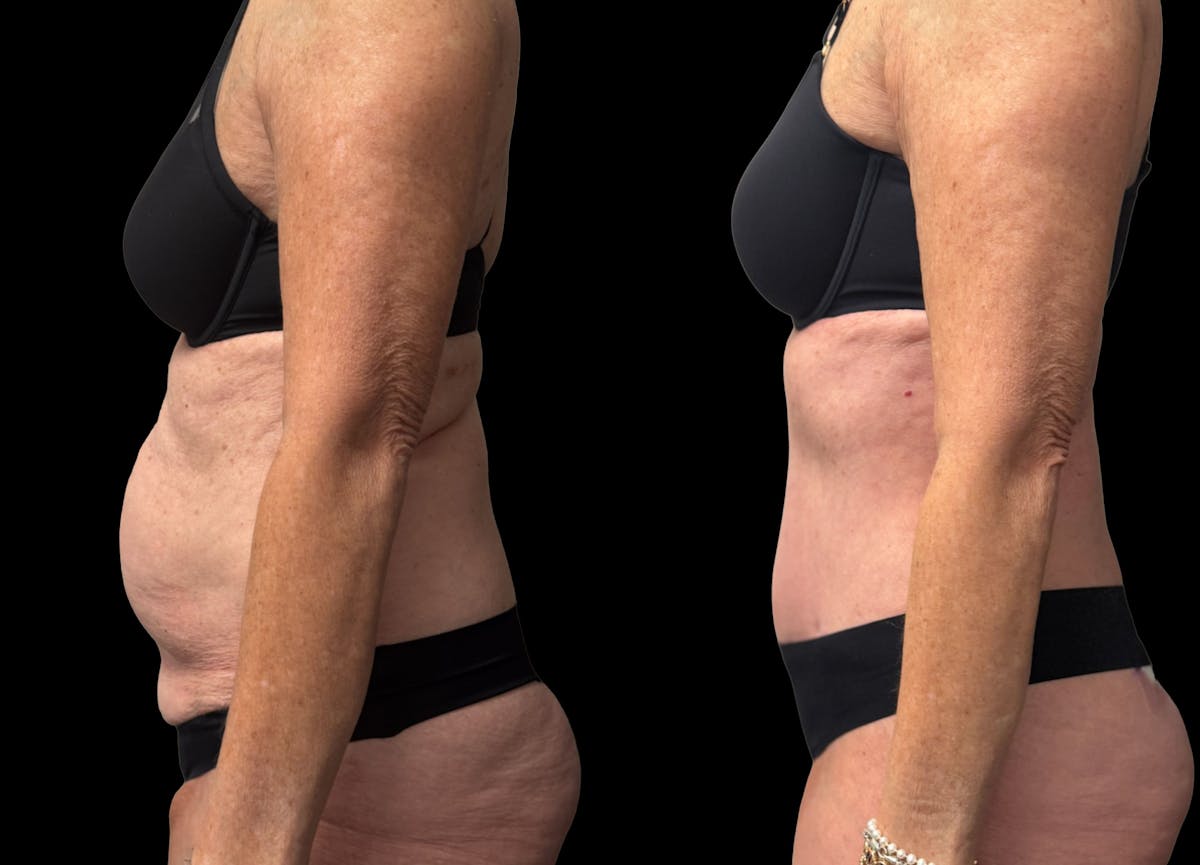 Tummy Tuck Before & After Gallery - Patient 197665 - Image 3