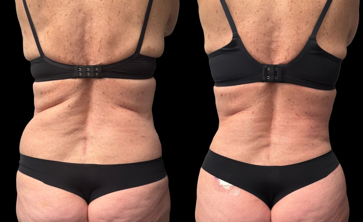 Tummy Tuck Before & After Gallery - Patient 197665 - Image 4