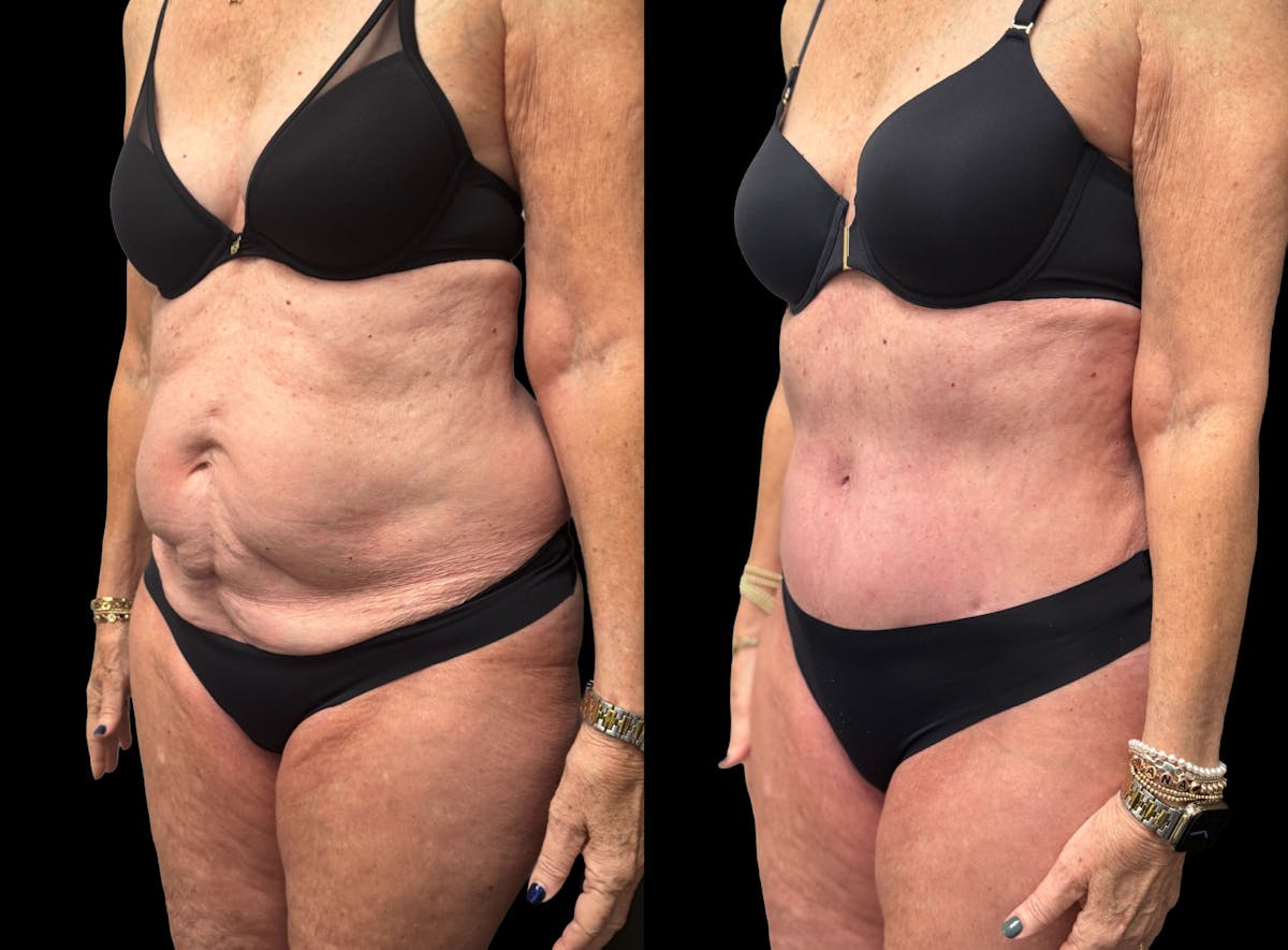 Tummy Tuck Before & After Gallery - Patient 197665 - Image 2