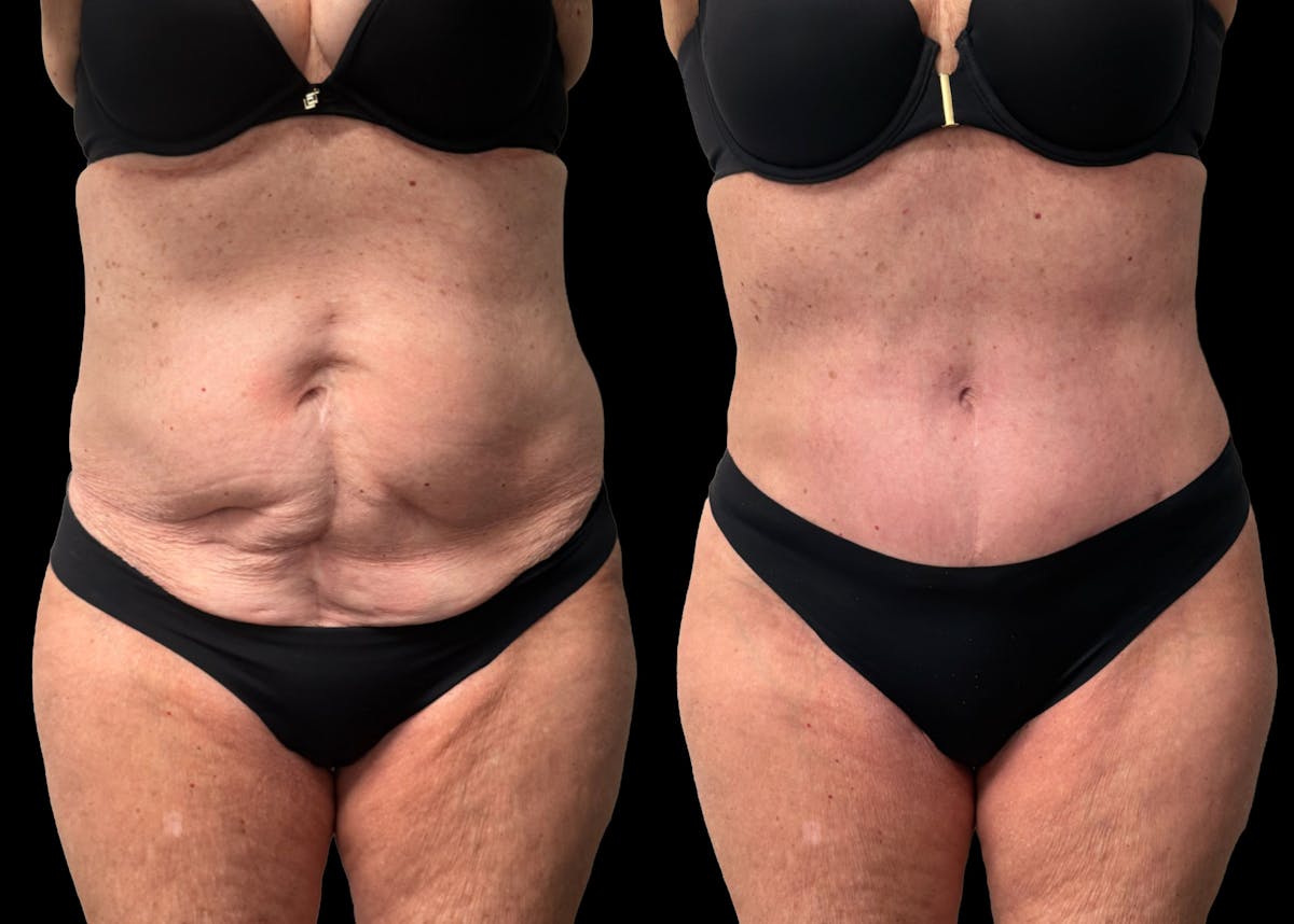 Tummy Tuck Before & After Gallery - Patient 197665 - Image 1