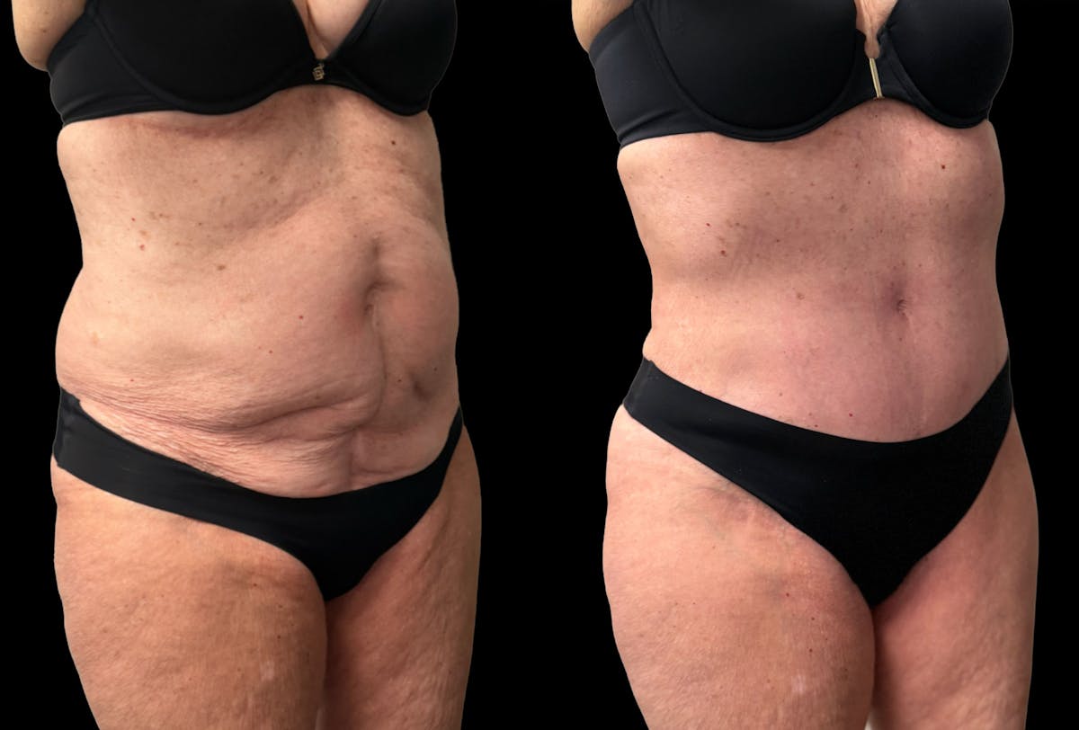 Tummy Tuck Before & After Gallery - Patient 197665 - Image 5